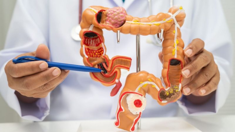 Câncer colorretal: entenda o impacto do consumo de ultraprocessados na saúde intestinal