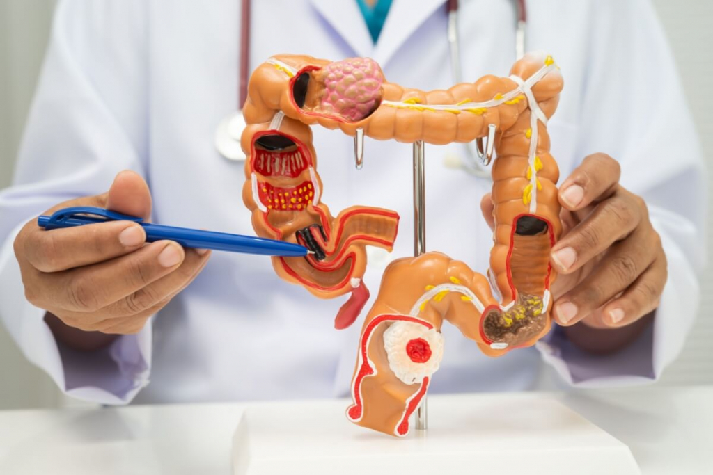 Câncer colorretal: entenda o impacto do consumo de ultraprocessados na saúde intestinal