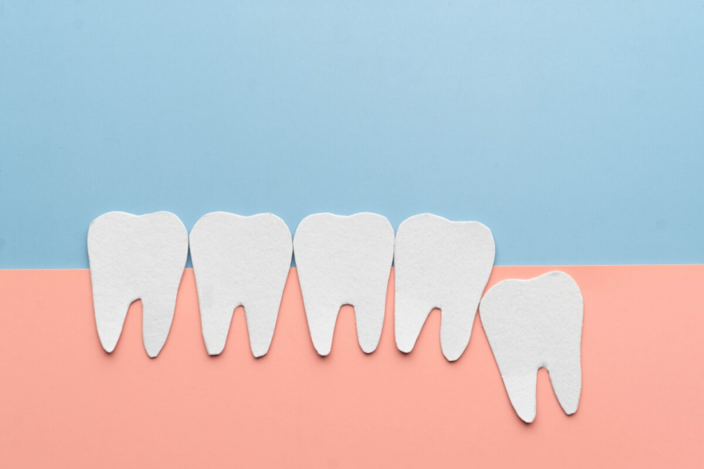 Dente do siso: por que algumas pessoas não têm?